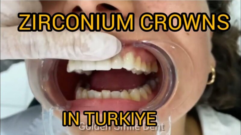 discover the beauty of zirconia crowns in turkey with golden smile dent