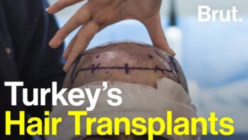 discover the allure of hair transplant tourism in turkey!