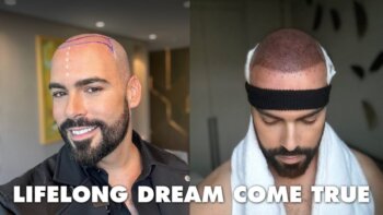 تجربة التحول: رحلة زراعة الشعر الشخصية مع هيرنيفا في اسطنبول، تركيا