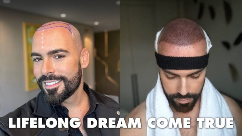 experience the transformation: a personal hair transplant journey with hairneva in istanbul, turkey