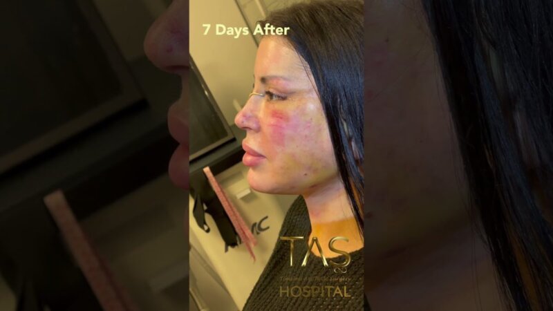 transform your look with scarless facelift, necklift & rhinoplasty by dr tas. experience the ultimate facial transformation.