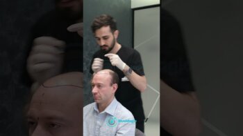 discover the wonders of hair transplant surgery in istanbul!